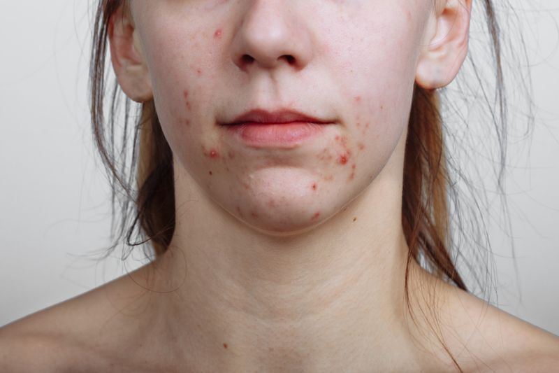 close up of young person s face with blemishes