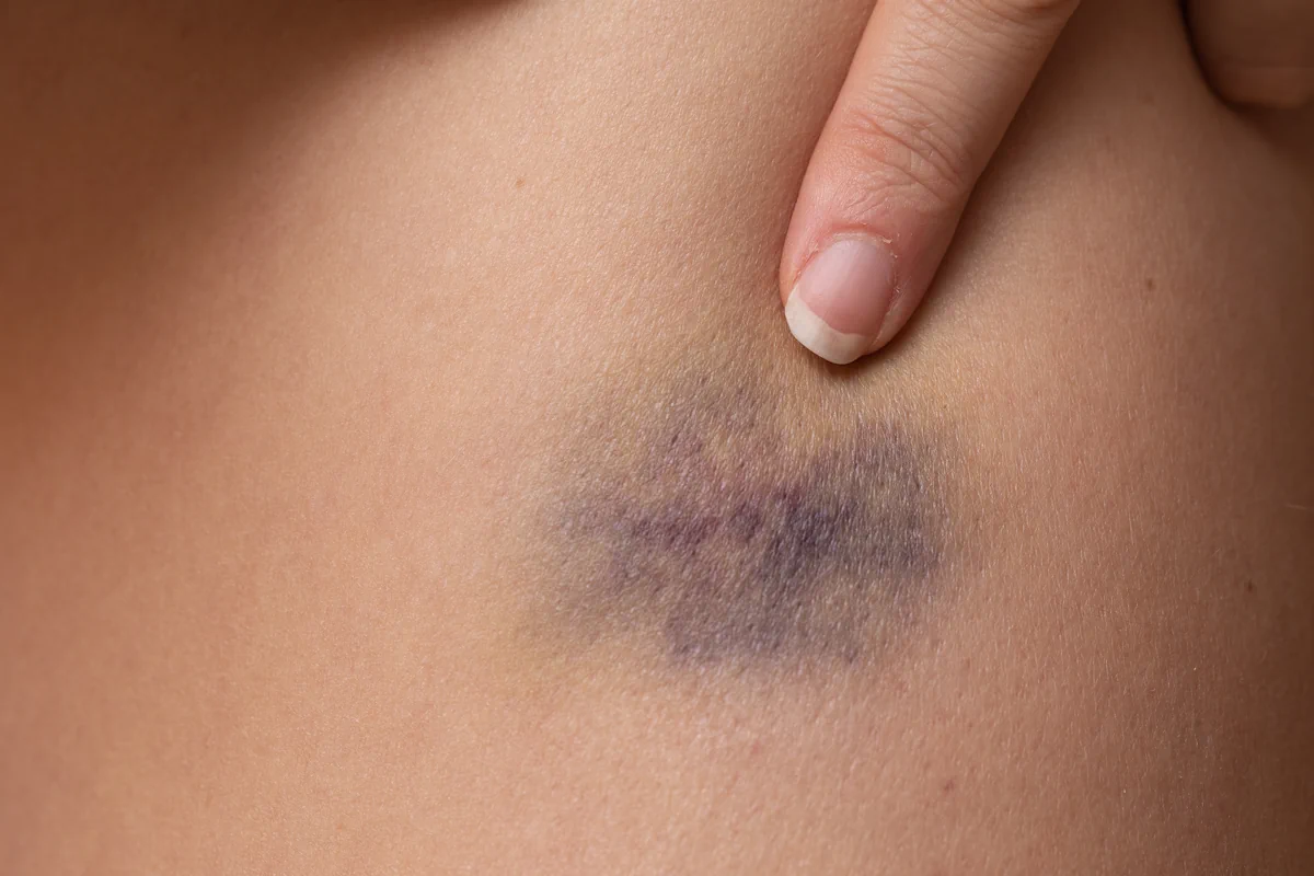 Une trace bleue sur une peau qu'une personne montre du doigt